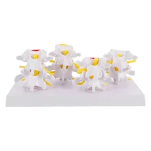 

Human Lumbar Lesion Spine Statue Display Model Lumbar Vertebra Spine Diseased Model