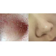 Eliminador de espinillas por calor, aspiradora de poros para nariz, cara, acné, succión, pantalla LCD recargable, herramientas de eliminación de puntos de succión