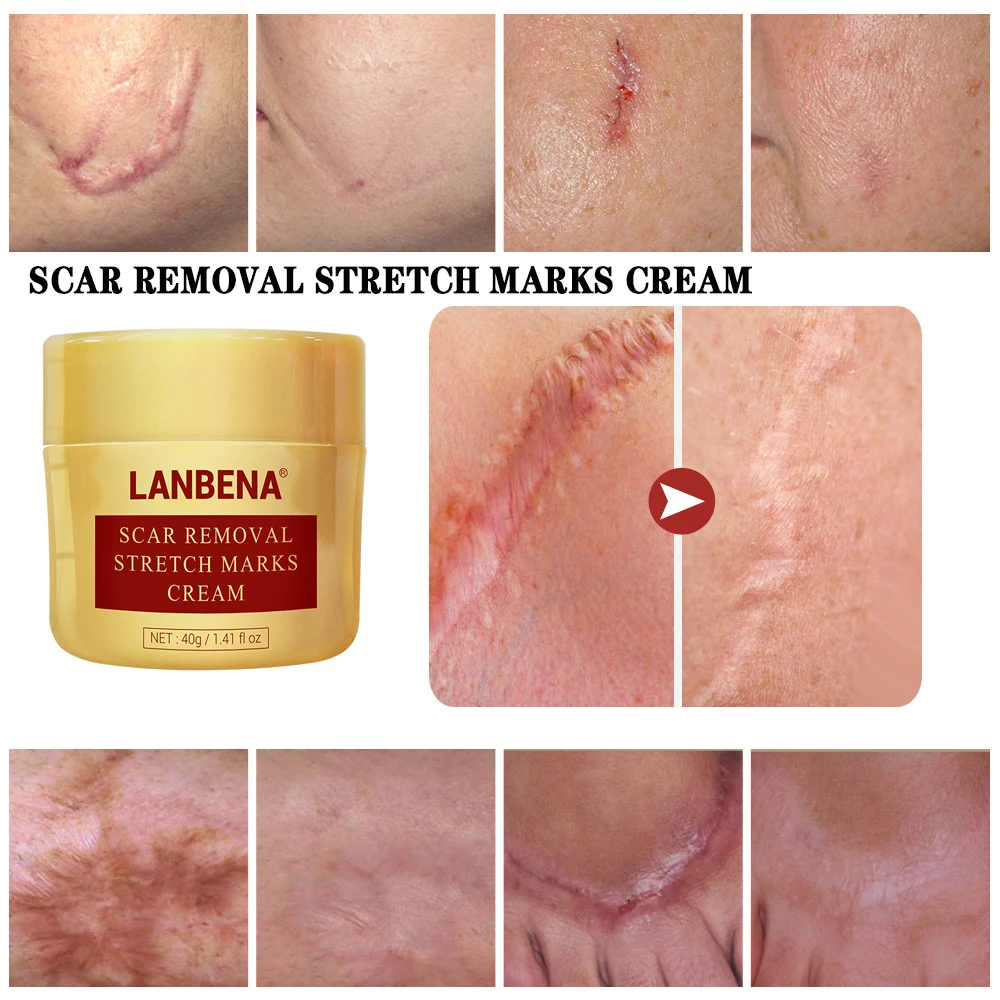 40g Scar Removal Cream Repair Acne mark Scar Treatment Blackhead Spots