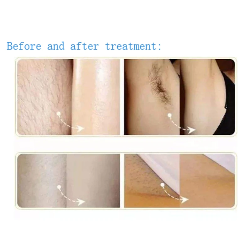 With 430/480/530/560/590/640/690nm Filters IPL OPT SHR Hair Removal Laser Machine Skin Care Rejuvenation For Permanent Use
