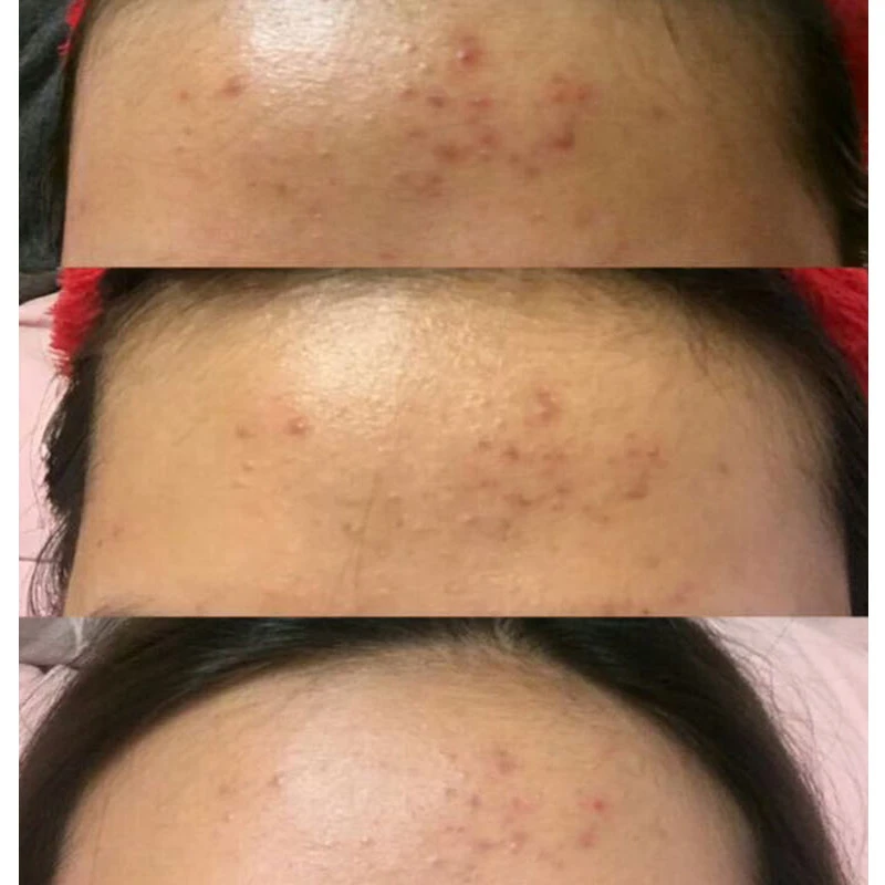 the ordinary clogged pores