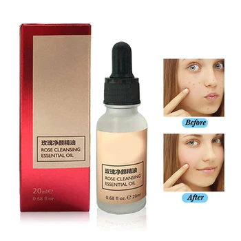 

20ML Rose Essential Oil Skin Tag Removal Remove Moles And Repair Scars Painless Dark Spot Clean Face Wart Freckle Removal Cream