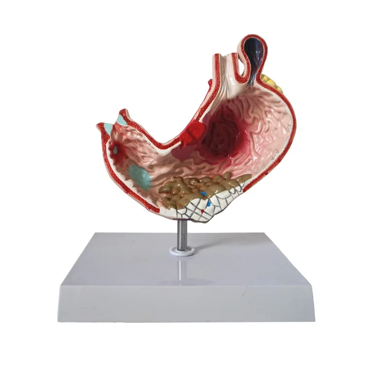 Menselijke-Maag-Anatomie-Medische-Maag-Pathologie-Gastritis-Maagzweer ...
