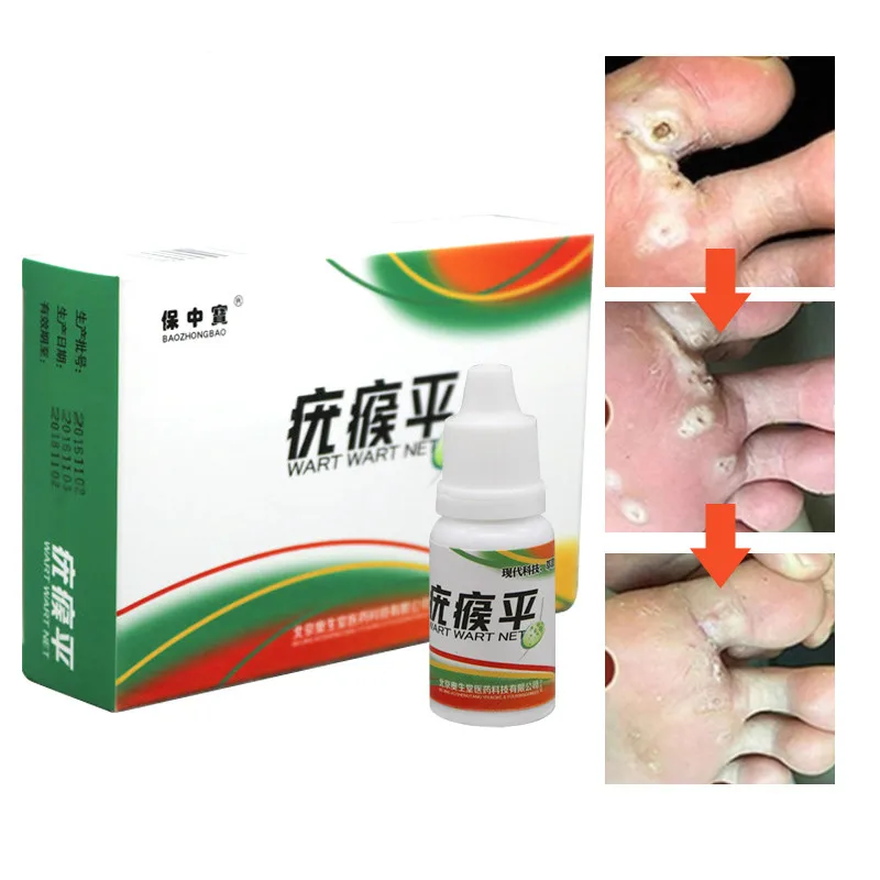 Skin-Tag-Mole-Wart-Remover-Eye-Skin-Tag-Remover-12-Hours-Remover-10ml-Body-Warts-Treatment (1)