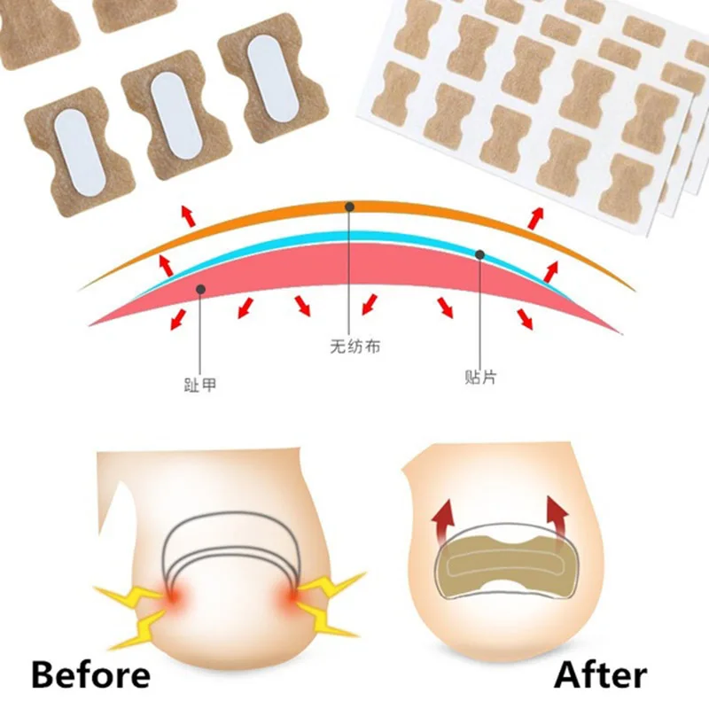 

10 pcs Nail Tape Stickers Anti-roll Nails Glue-free Toe Inlay Nails Corrector Nail Patch Pull Manicure Dedicated Sticker