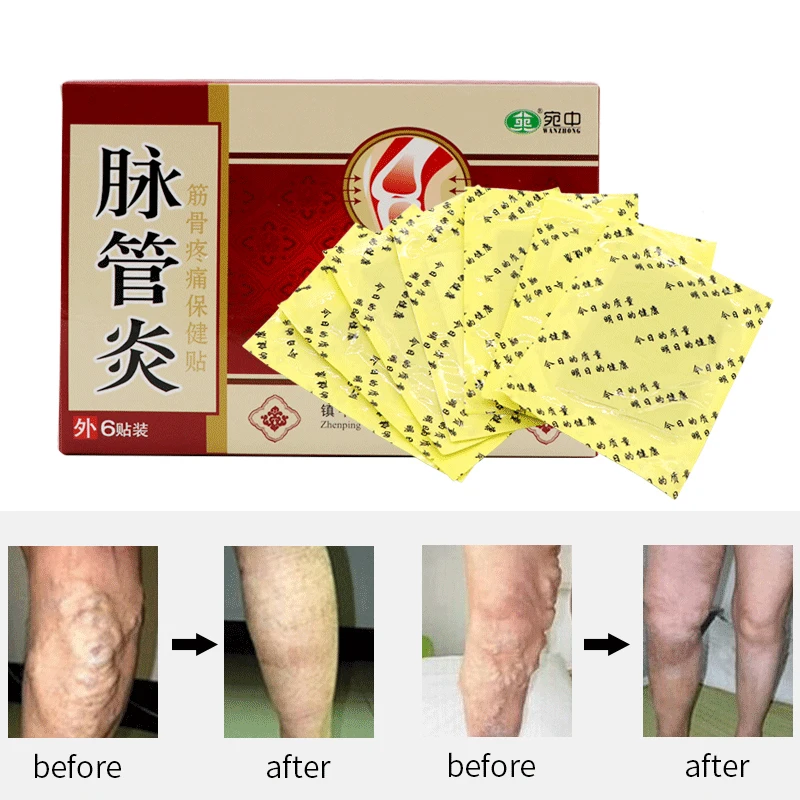 24PCS Chinese Traditional herbal medicine Patches Cure Spider Veins Varicose Treatment Plaster Varicose Veins Vasculitis Natural