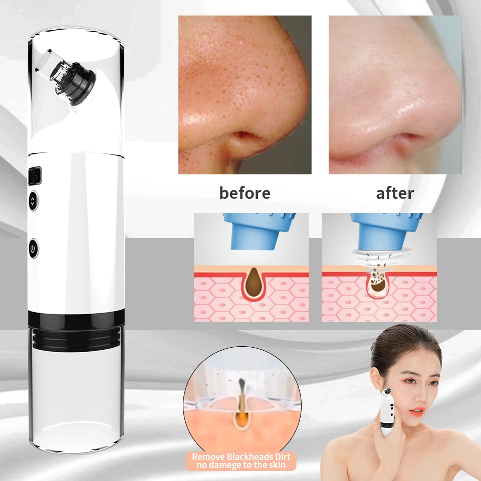 bubble blackhead remover