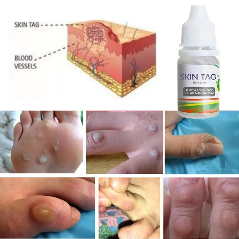 

Skin Tag Remover Foot Care Cream 10ml Genital Wart Remover Treatment Foot Corn Removal Blackhead Remover Cream TSLM2