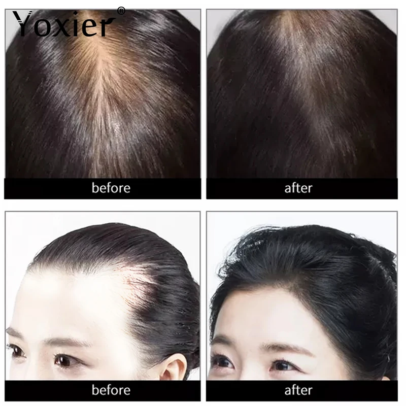 Yoxier New Hair Growth Essence Oil Effective Extract Anti Nourish Hair Roots Treatment Preventing Hair Loss 4