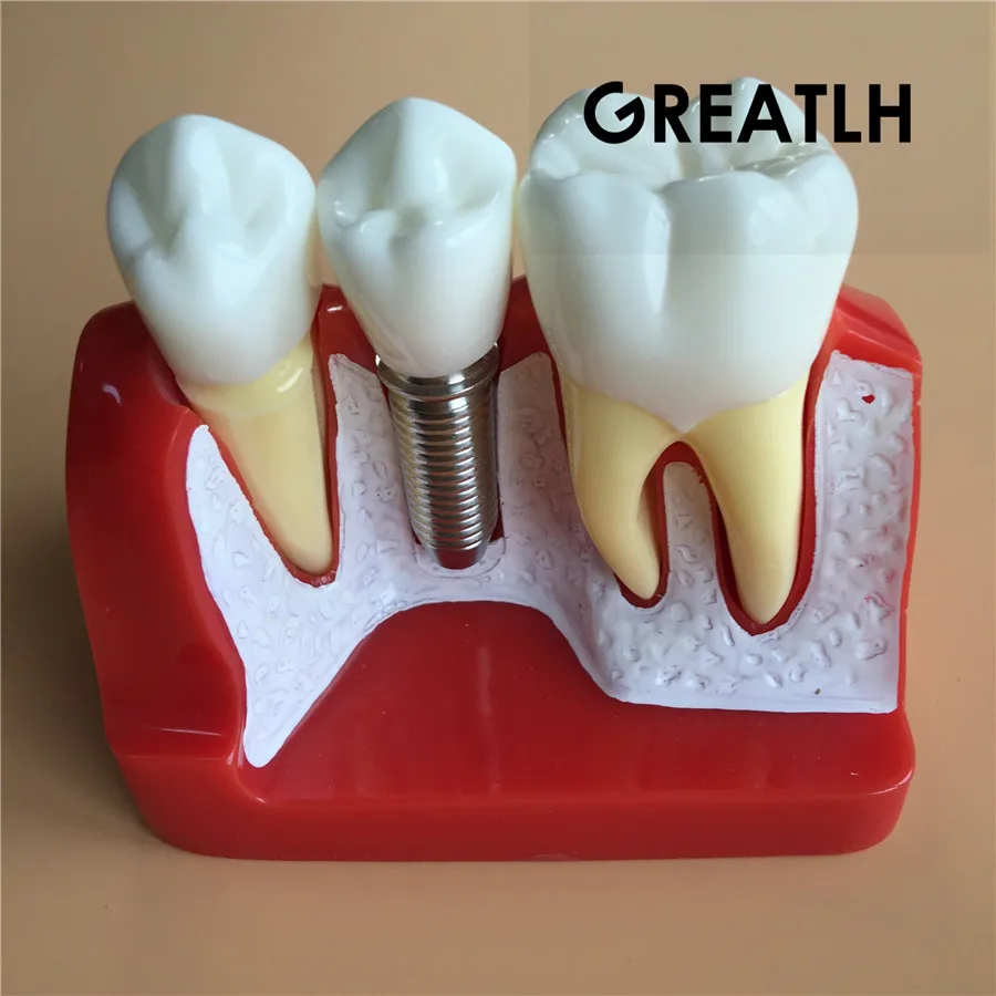 

Dental Teaching Model Dental Implant Analysis Crown Bridge dental demonstration model