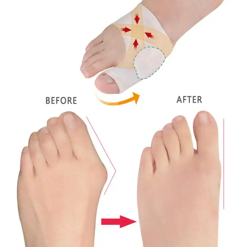 Big Bone Orthopedic Bunion Correction Pedicure Socks Silicone Hallux Valgus Corrector Braces Toes Separator Feet Care Tool TSLM1