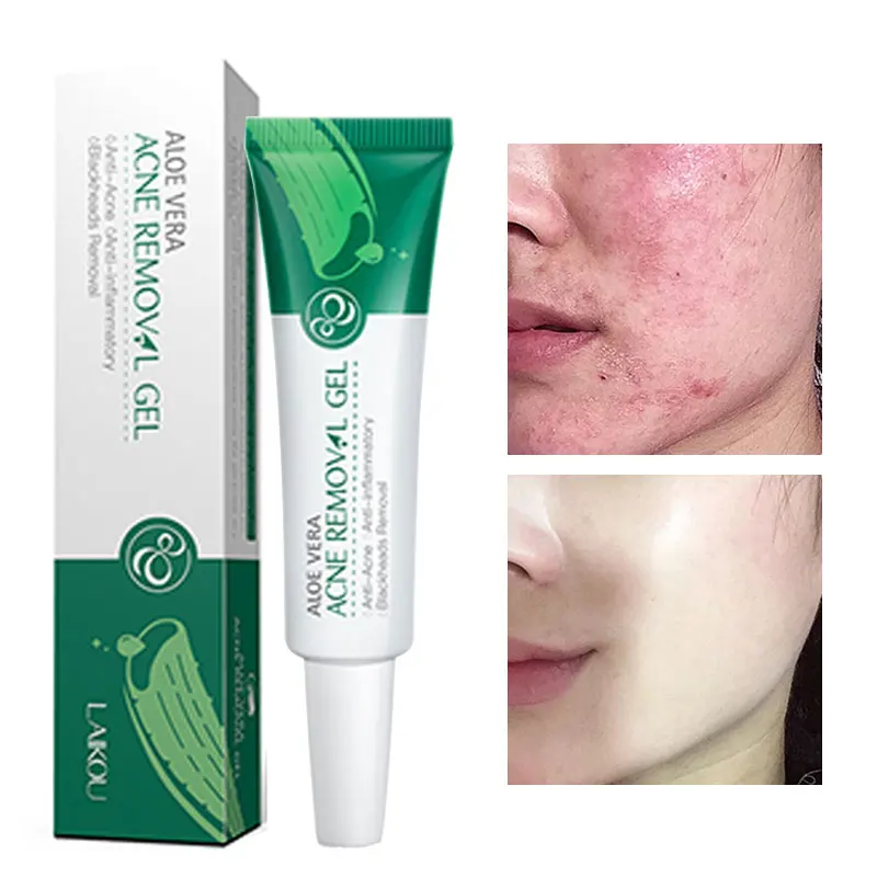 

Remove Acne Gel Nourish Moisturizing Acne Treatment Anti-Aging Repair Firming Lifting Oil-Control Aloe Vera Beauty Skin Care 20g