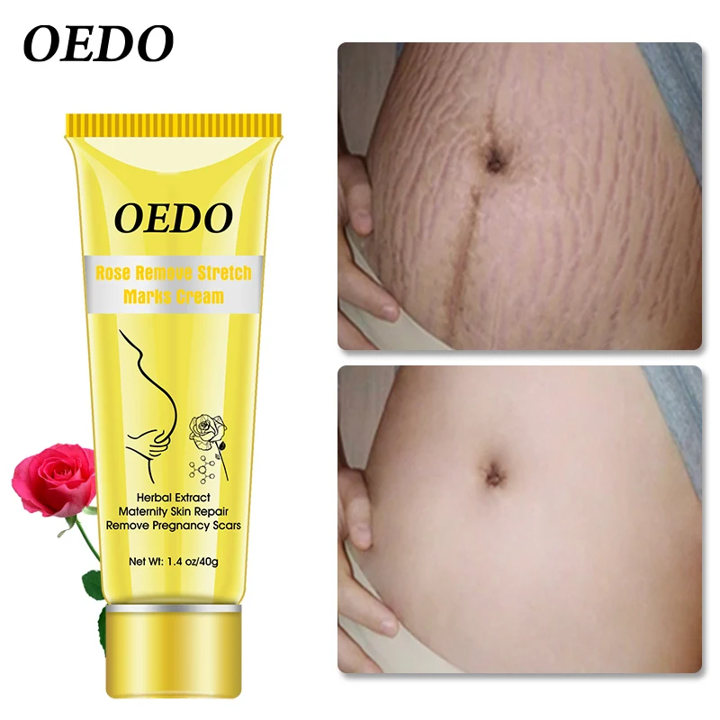 oedo rose remove stretch marks