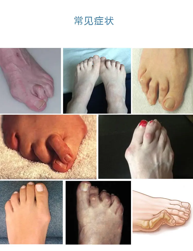 Toe Curved Brace Claw Toe Hammer Hammertoes Two Toes Straightening Transformation Overlap Correction of Hallux Toe Valgus Adult