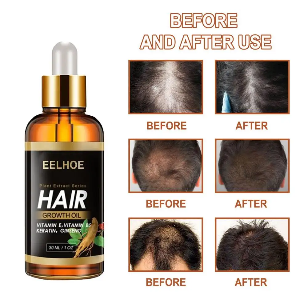 30g Vitamin E Oil For Long Hair Growth Natural Ginseng Hair Growth  Thickening Essence Oil Hair Loss Treatment Serum Hair Care - Hair Loss  Product Series - AliExpress