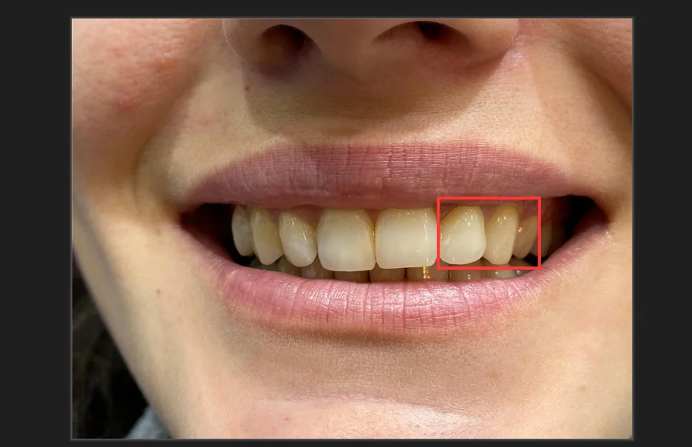 5 pieces sirona UT EX extreme aesthetics multlayer ultra translucency high strength zirconia blocks
