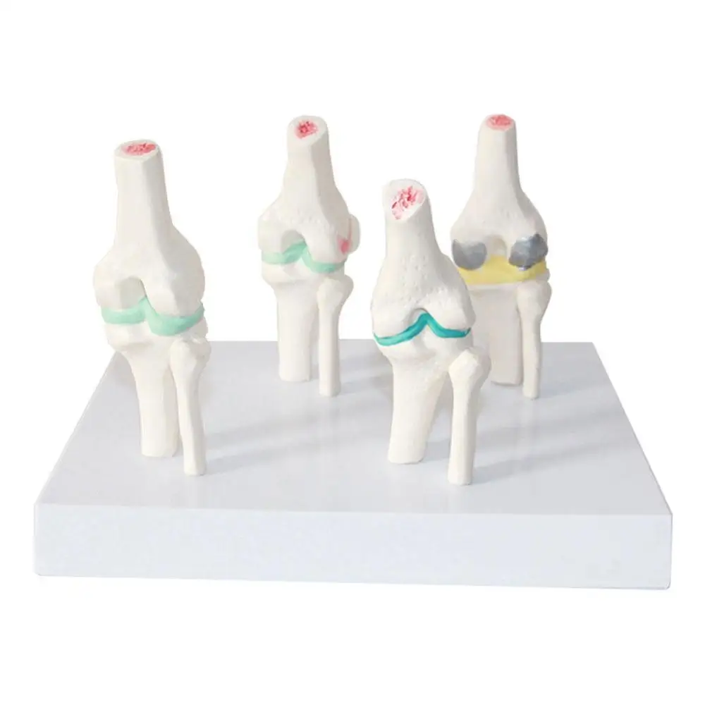 

Anatomical Human Degenerative Knee Joint Disease Model Medical Skeleton Anatomy Teaching Resources