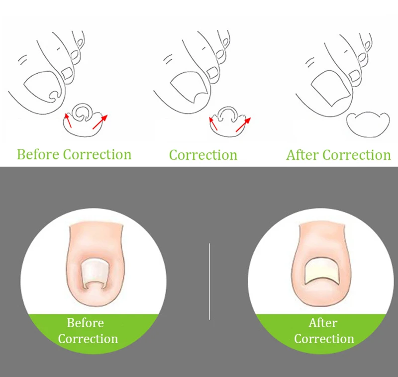 1 шт. полезный вросший ноготь коррекция ног Инструмент Педикюр закрепитель для ногтей на ногах Уход за ногтями на ногах инструмент ортопедический корректор для педикюра инструмент