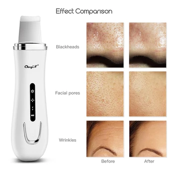 

Hot Ultrasonic Electric Facial Skin Scrubber Sonic Vibration Dead Skin Blackhead Removal Shovel Comedone Extractor Face Cleaner