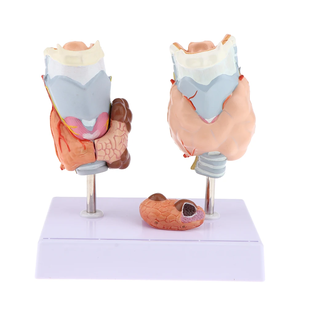 Human Anatomical Thyroid Gland Pathology Anatomy Medical Teaching Model - Lab Supplies Science Classroom Education