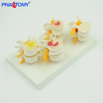 

Medical props model human lumbar lesion spine structure display model 1 set medical teaching learning tool life size PNATOMY