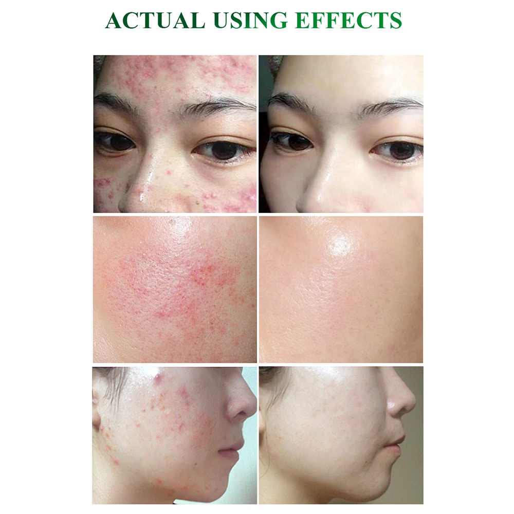 BREYLEE Tea Tree Acne Solution Kit Acne Treatment Serum Face Cream Pimple Removal Essence