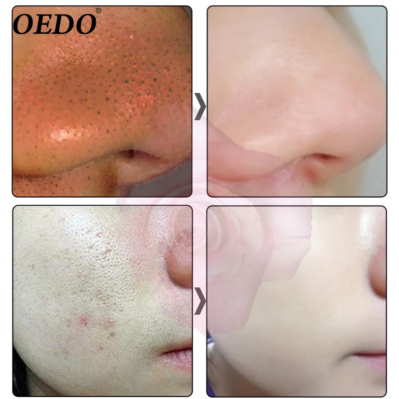 OEDO уход за кожей лица, очищающее средство для пор, гиалуроновая кислота, женьшень, очищение угрей, уход, средство для умывания лица