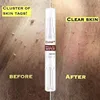 3ml Wipe Off Tags & Moles Pen For Callus Gram Warts Foot Remover Liquid Genital Wart Removal Treatment Pen Skin Beauty ► Photo 2/6