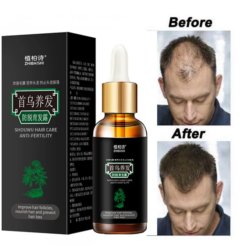 Cuidado del cabello para el crecimiento del cabello aceites esenciales esencia crecer cabello para prevenir la pérdida de cabello salud belleza suero denso para el crecimiento del cabello