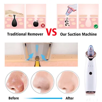 

Electric Acne Remover Point Noir Blackhead Vacuum Extractor Tool Black Spots Pore Cleaner Skin Care Facial Pore Cleaner Machine