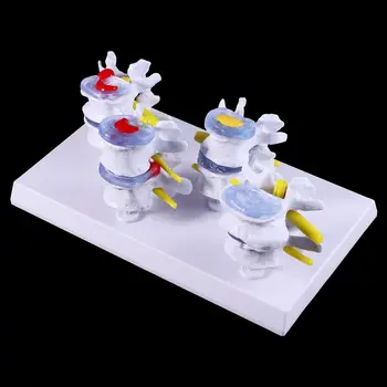 

1 Set Human Lumbar Lesion Spine Statue Display Model Teaching Learning Tool