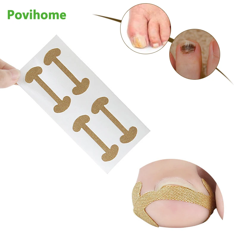 20pcs Ingrown Toenail Corrector Stickers Foot Fingernail Pain Reliving Patch Pedicure Tools Health Care Protects Plasters D2428