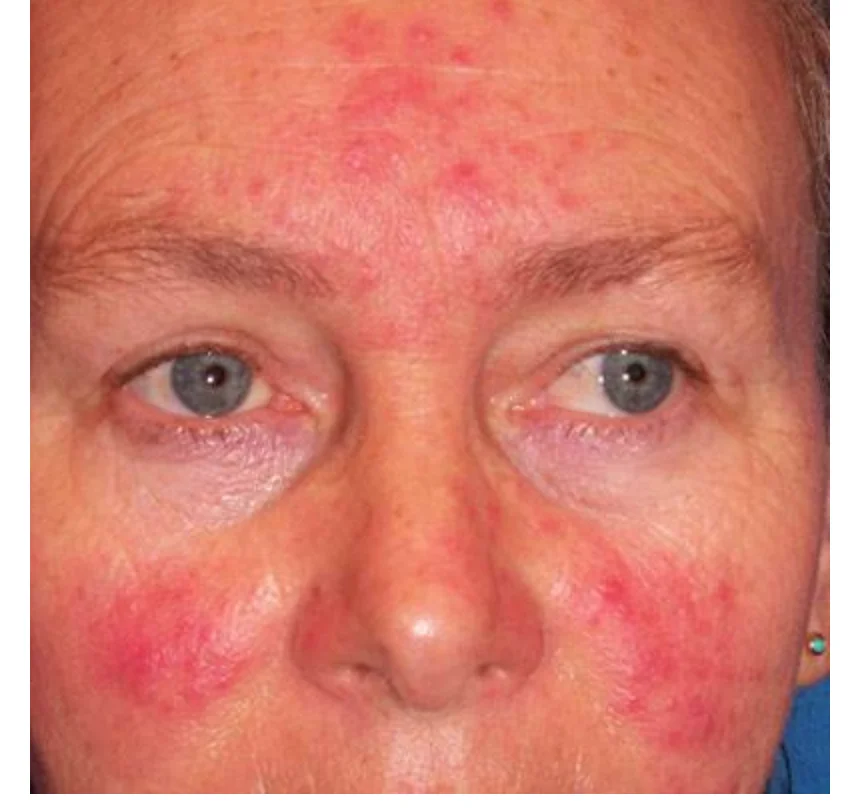 Крем Rosacea для носа красная мазь удаления черных точек и акне крем ухода за кожей