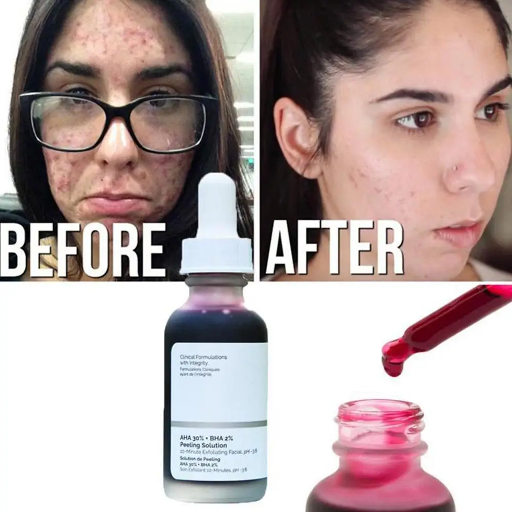 

The Ordinary AHA 30% + BHA 2% Peeling Solution 30ml 10mins Exfoliating Mask Facial Serum Remove Acne Scars Whitening Skin Care