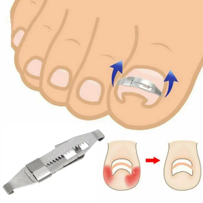Ingrown Toenail Corrector Toenail Correction Treatment Corrector Foot Embed Orthotic Tools Nail Tool Fixer Recover Pedicure S1H3 Ingrown Toenail Corrector Toenail Correction Treatment Corrector Foot Embed Orthotic Tools Nail Tool Fixer Recover Pedicure S1H3