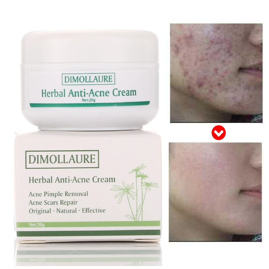 

Dimollaure 20g Acne Treatment Blackhead Removal Anti Acne Cream Oil Control Repair Comedone Pimple Acne Scar Remove Face Care