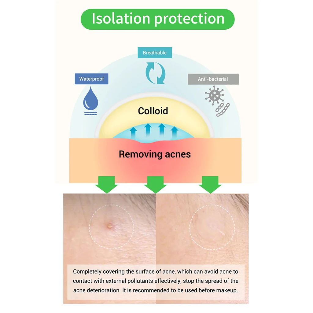 BREYLEE Face Acne Dots Hydrocolloid Spot Skin Patch Clear Zit Blemish Facial Masks Pimples Remover Tools Pimple Patch Stickers