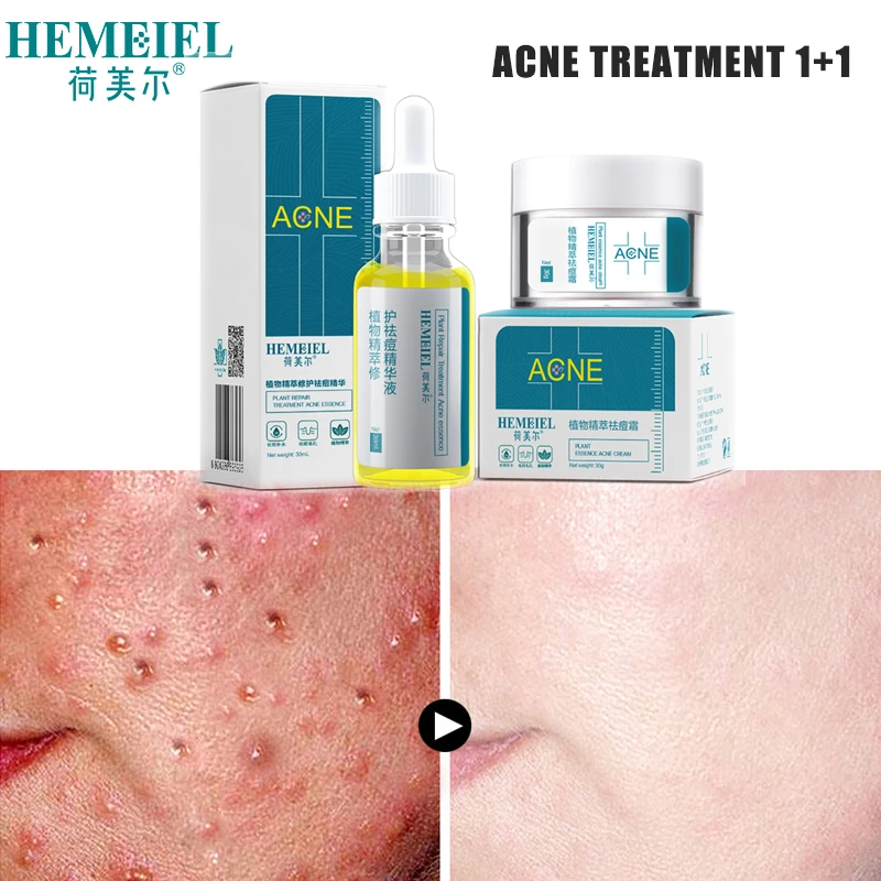 herbal acne treatment