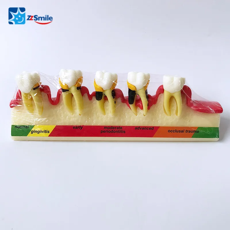 M4010 стоматологический периодонтальный болезни модель для демонстрации