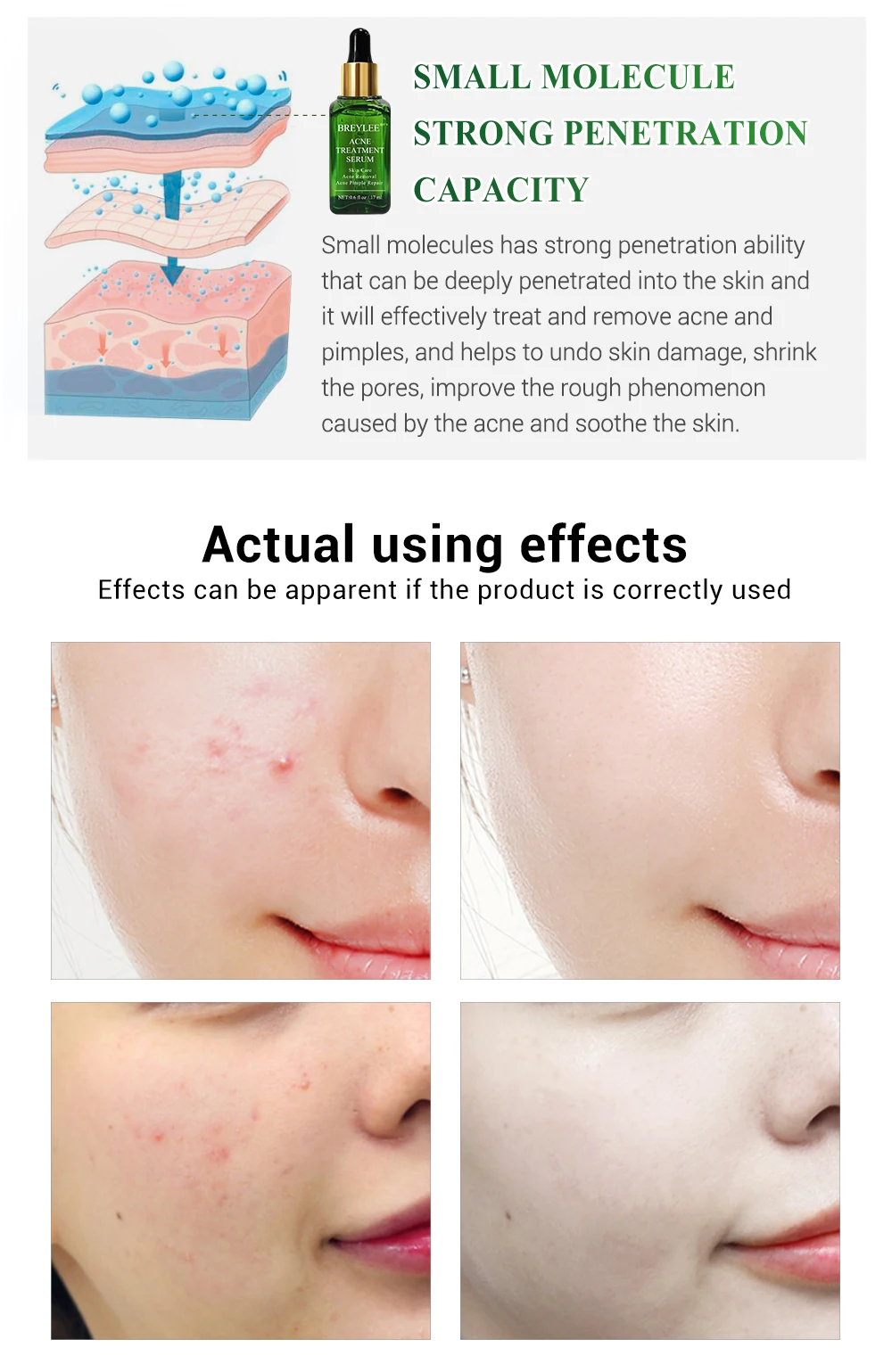 acne treatment