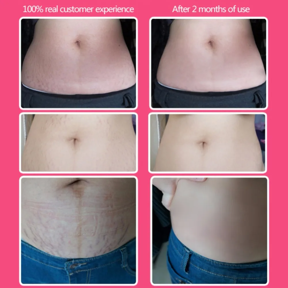 Body Repair Cream Powerful Stretch Marks Pregnancy Scar Removal Maternity Skin Smooth Skin Cream