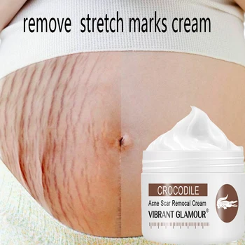 

Removal of stretch marks on the bellyMs. Pregnancy repair cream facial acne scar skin care