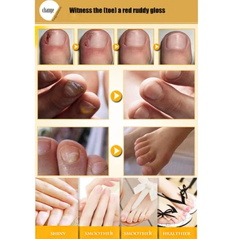 

Useful Fungal Nail Treatment Essence Toe Nail Finger Anti Fungus Infection 30ml