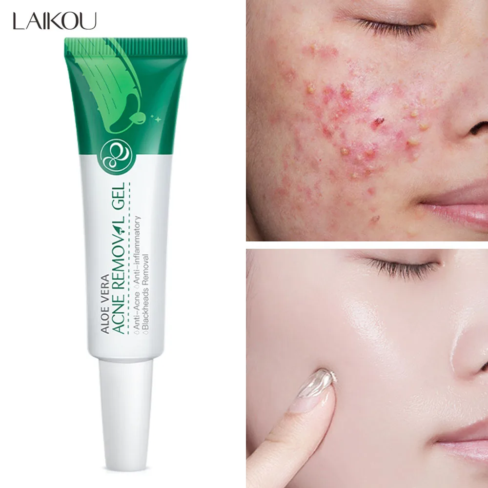 

LAIKOU Acne Removal Cream Gel Aloe Anti Acne Scar Treatment Soothing Repair Aloe Gel Oil Control Acne Remover Facial Care 20g