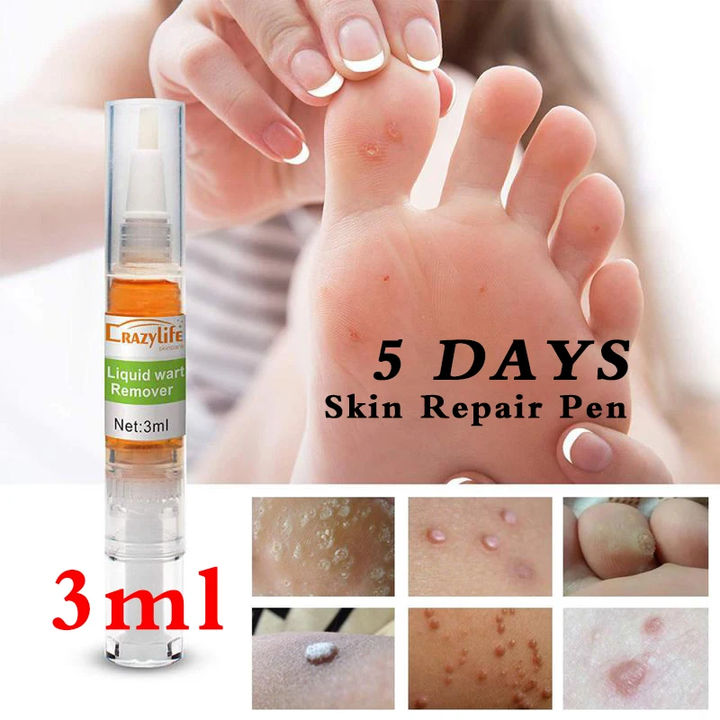 2Pcs Crazylife foot cleft removal toe wart liquid wart pen skin tag