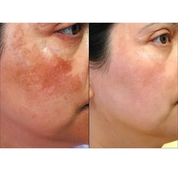 

30g/90g Chloasma,freckles, genetic spots, age spots, men and women, remove blemish products,herbal whitening cream