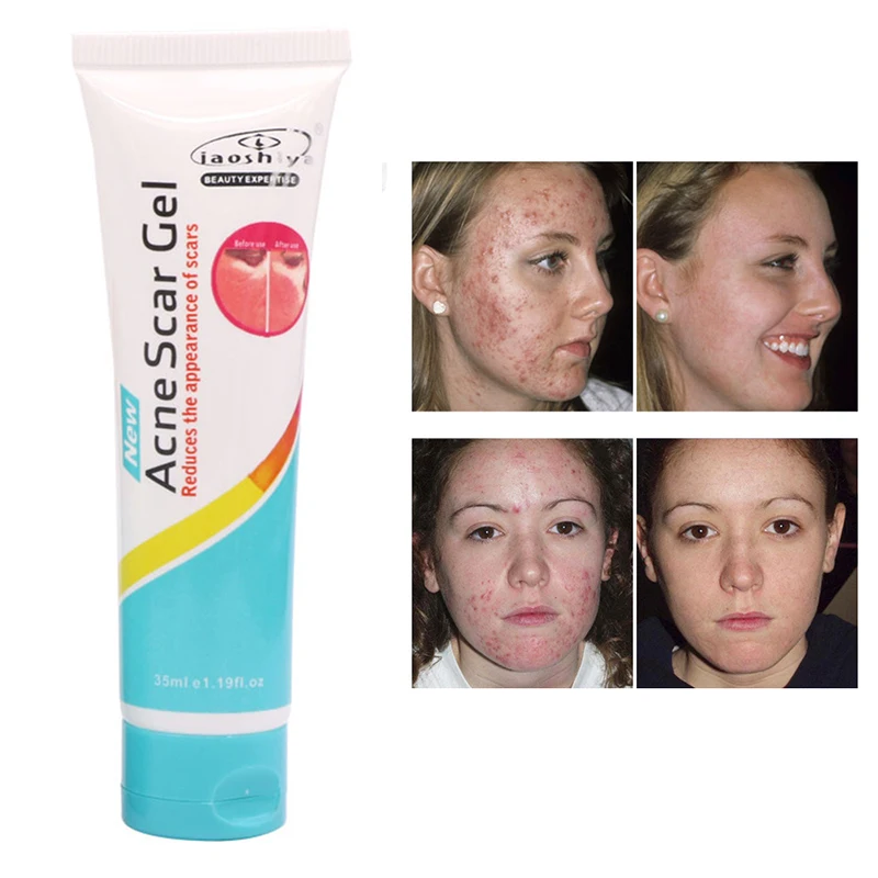 scar gel for acne