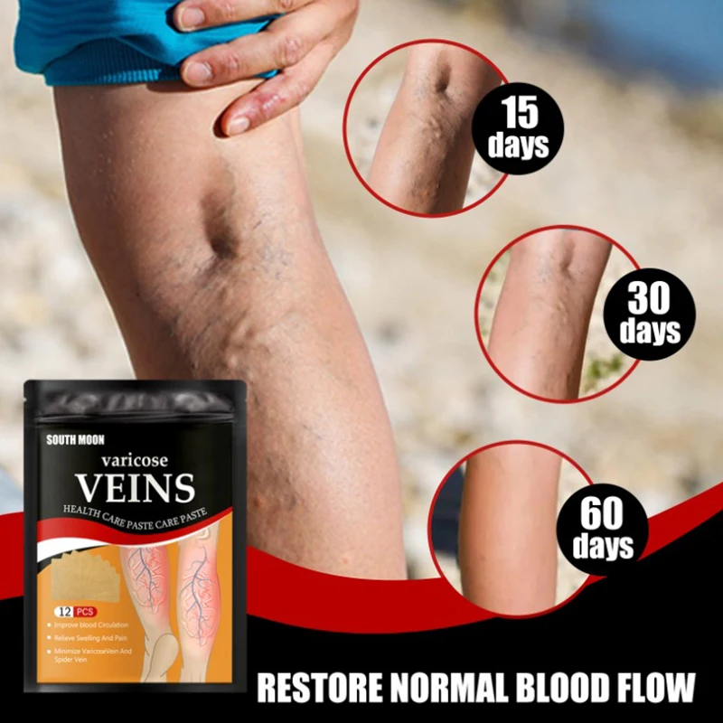 12Pcs/bag Varicose Veins Patch Remove Angiitis Dilated Vasculitis Spider Legs Chinese Medical Plaster Improves Blood Circulation pain relief patch blood sugar patch anti cough plaster urine leakage patch