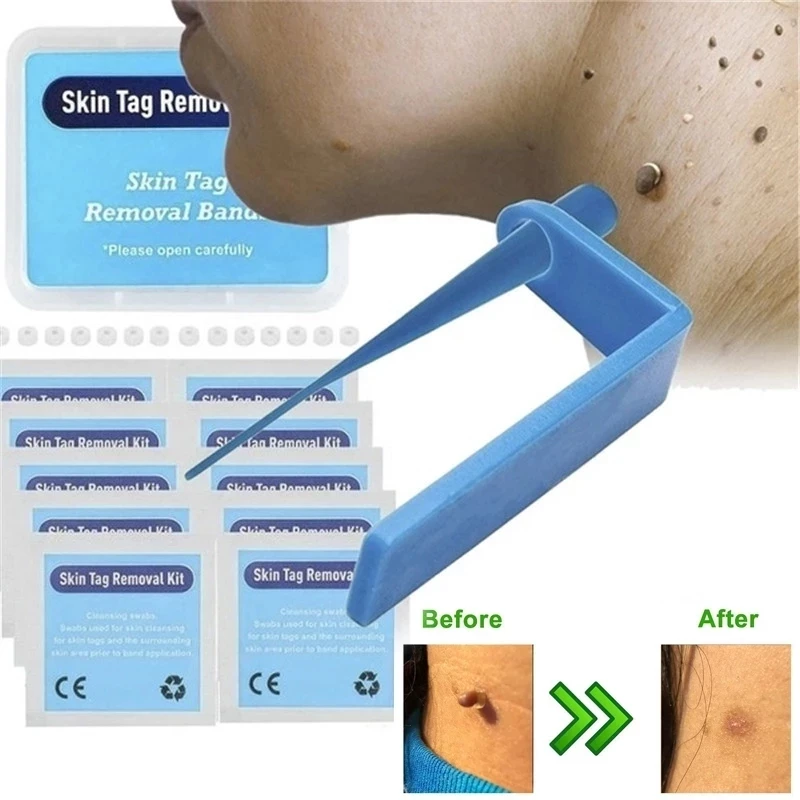 Набор бородавок, 5 шт. Micro skins. Skin tag remover patches инструкция на русском языке. Использование skin tag remover patches. Scholl's freeze away skin tag remover.