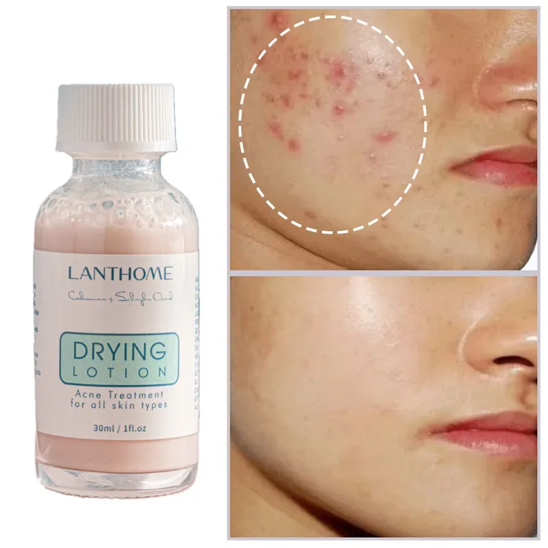 Calamine Drying Lotion Acne Treatment Face Serum Mask Anti Acne Pimple Scar Remover Moisturizing